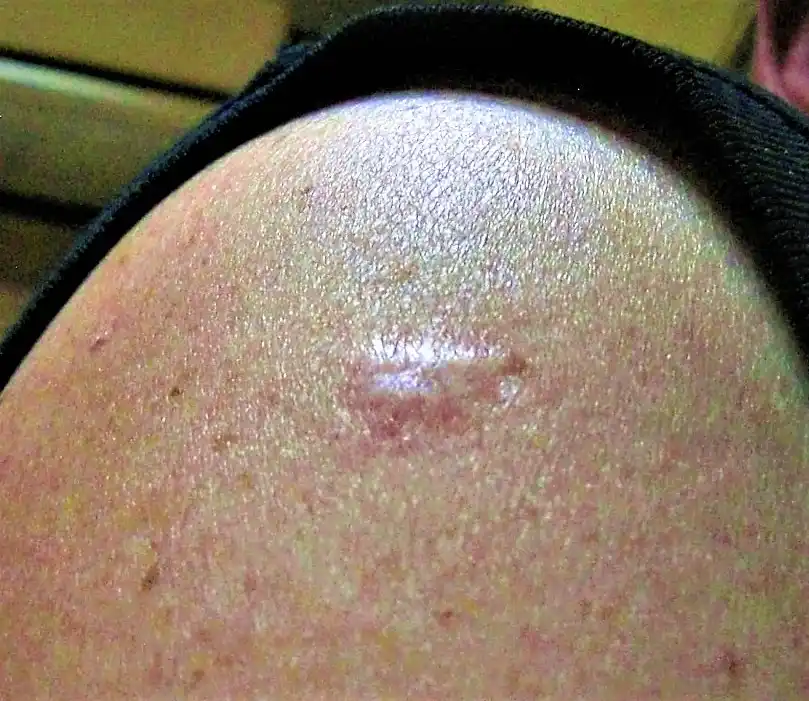 Hypertrophic Scar